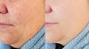 HOW CAN I TREAT ROSACEA?