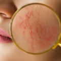 WHAT IS ROSACEA?