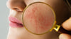 WHAT IS ROSACEA?